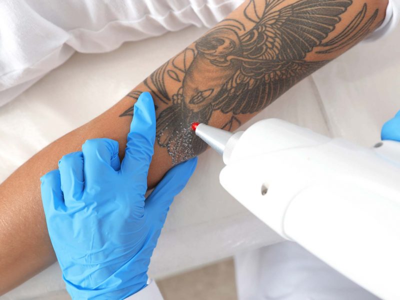Oriental Touch Jasmin Tattoo Entfernung Oriental Touch Jasmin Tattoo Entfernung